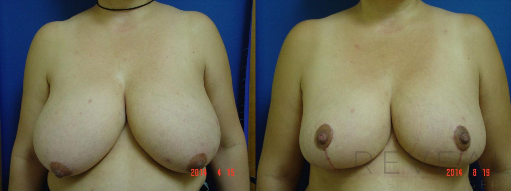 Before & After Breast Reduction Case 154 View #1 View in San Jose, CA