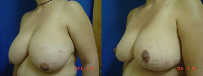 Before & After Breast Reduction Case 154 View #2 View in San Jose, CA