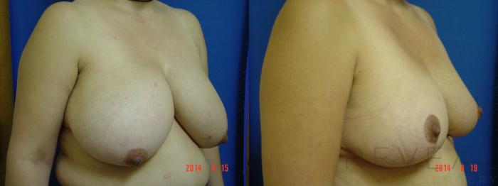 Before & After Breast Reduction Case 154 View #3 View in San Jose, CA
