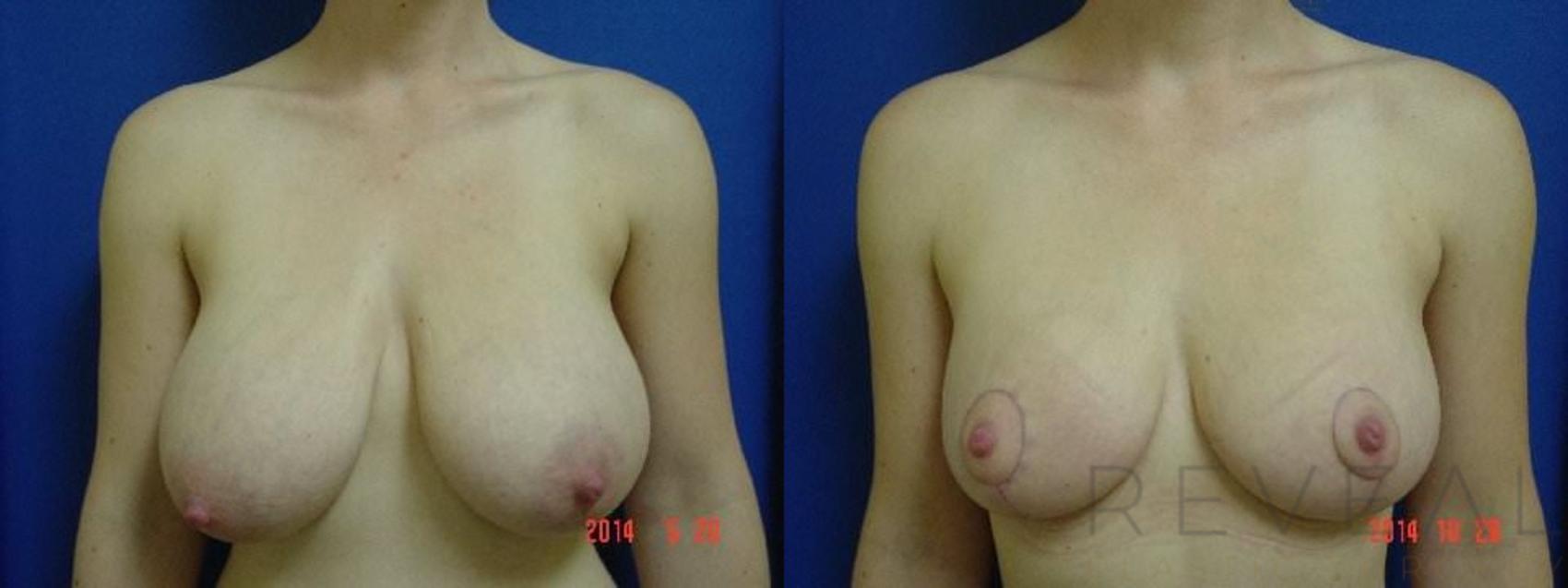 Before & After Breast Reduction Case 161 View #1 View in San Jose, CA