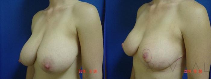 Before & After Breast Reduction Case 161 View #2 View in San Jose, CA