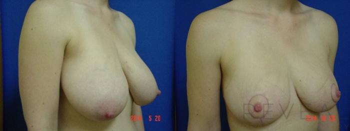 Before & After Breast Reduction Case 161 View #3 View in San Jose, CA