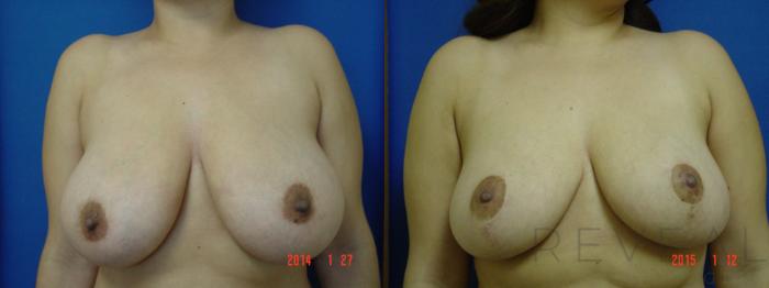 Before & After Breast Reduction Case 168 View #1 View in San Jose, CA