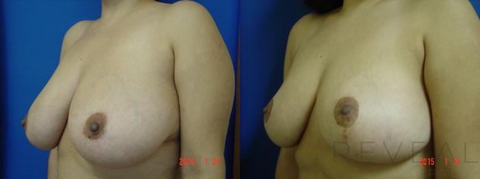 Before & After Breast Reduction Case 168 View #3 View in San Jose, CA