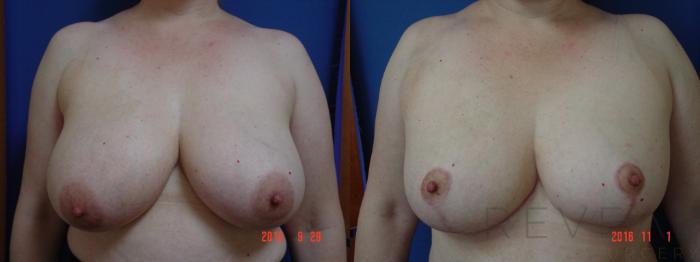 Before & After Breast Reduction Case 202 View #1 View in San Jose, CA