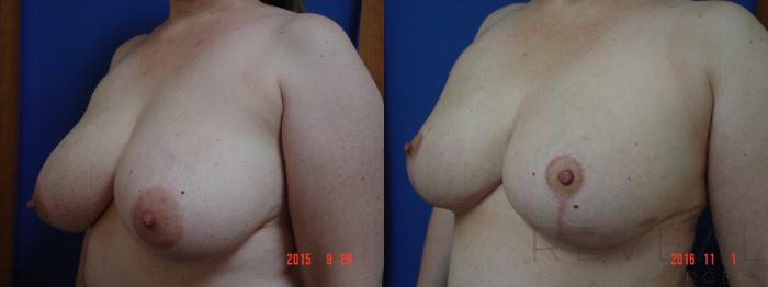 Before & After Breast Reduction Case 202 View #2 View in San Jose, CA