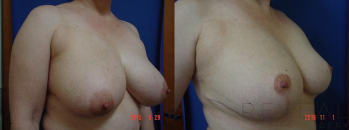 Before & After Breast Reduction Case 202 View #3 View in San Jose, CA