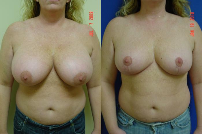 Before & After Breast Reduction Case 21 View #1 View in San Jose, CA