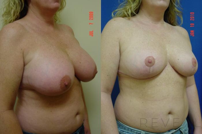 Before & After Breast Reduction Case 21 View #2 View in San Jose, CA