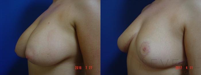 Before & After Breast Reduction Case 213 View #1 View in San Jose, CA