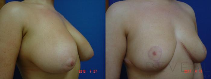 Before & After Breast Reduction Case 213 View #2 View in San Jose, CA