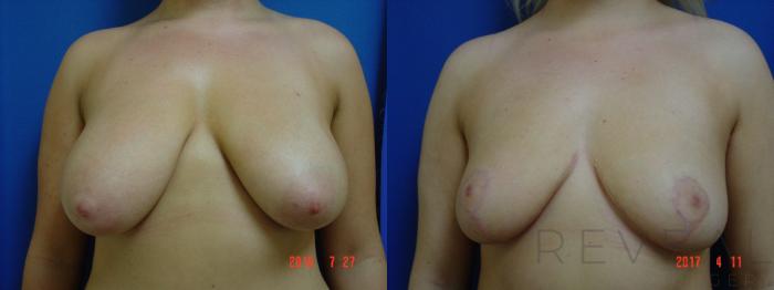 Before & After Breast Reduction Case 213 View #3 View in San Jose, CA
