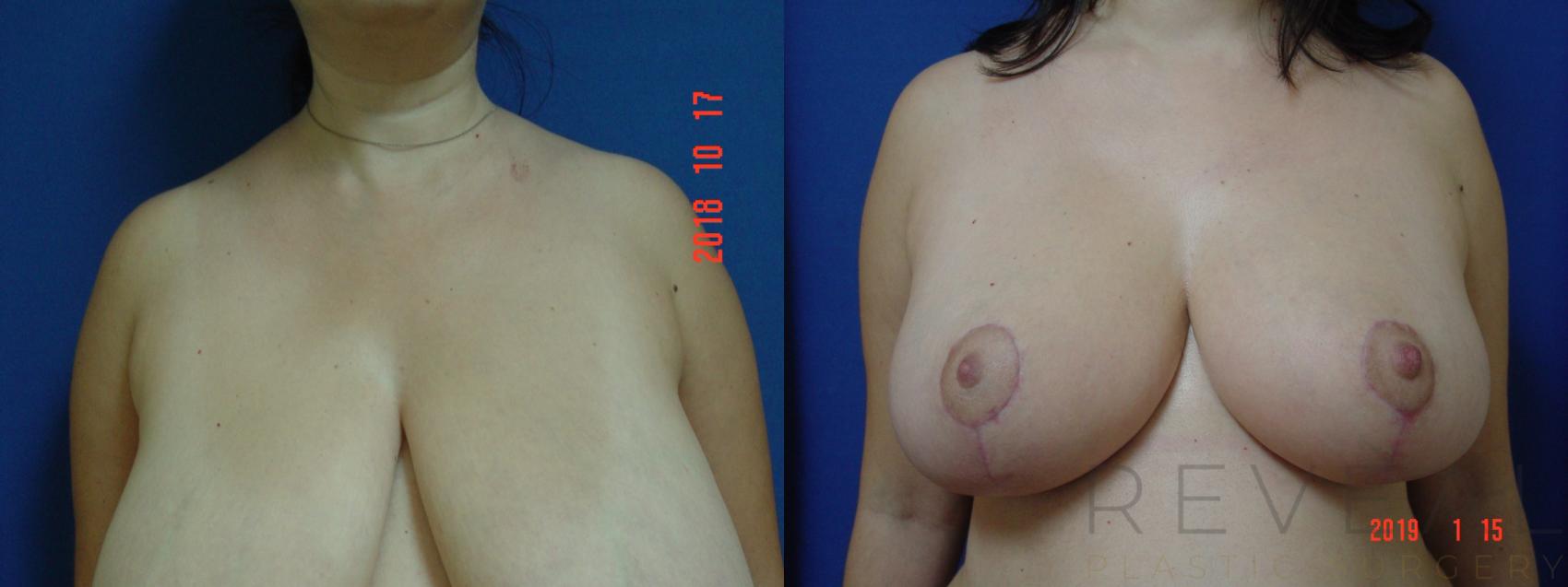 Before & After Breast Reduction Case 283 View #1 View in San Jose, CA