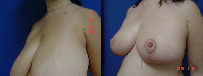 Before & After Breast Reduction Case 283 View #2 View in San Jose, CA