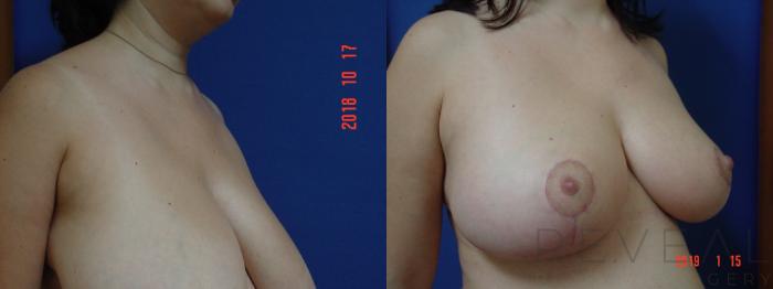 Before & After Breast Reduction Case 283 View #3 View in San Jose, CA