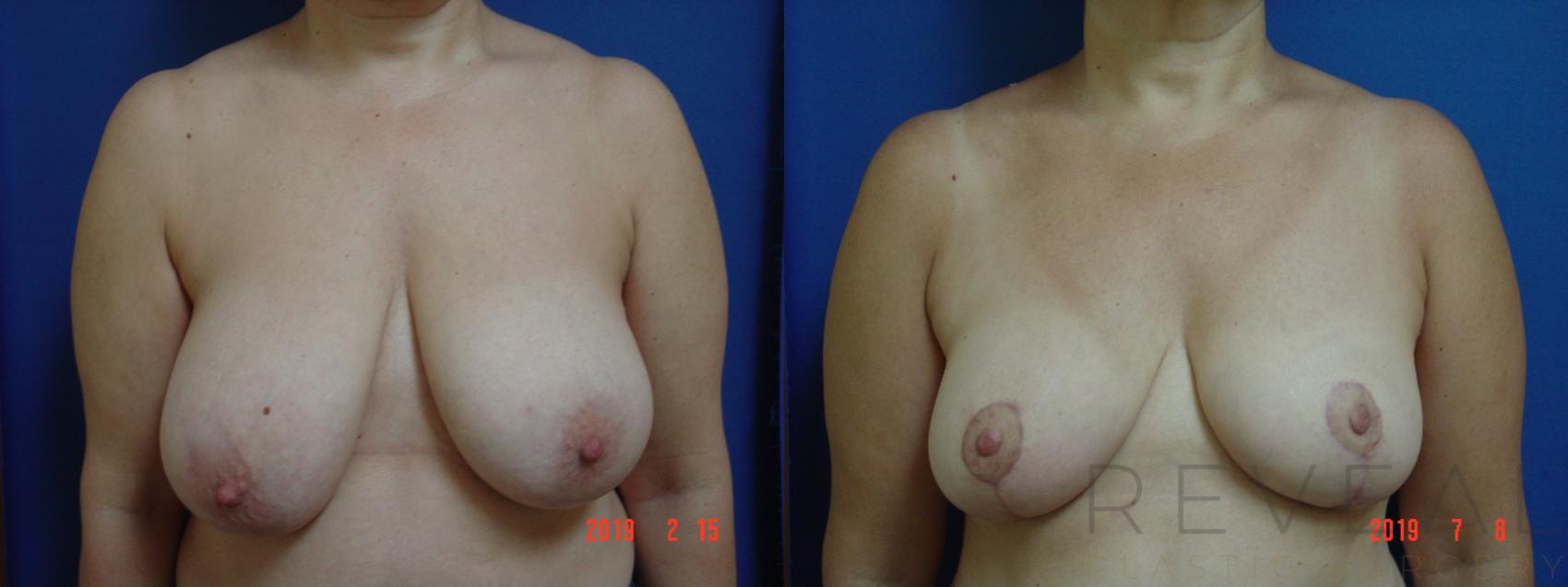 Before & After Breast Reduction Case 357 View #1 View in San Jose, CA
