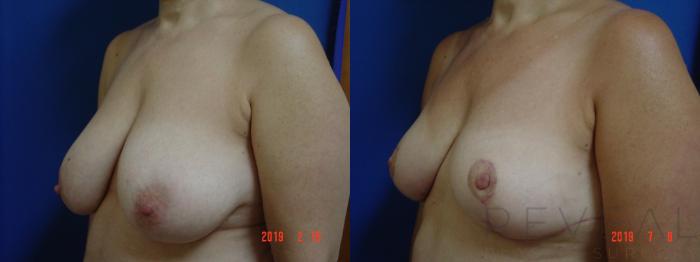 Before & After Breast Reduction Case 357 View #2 View in San Jose, CA