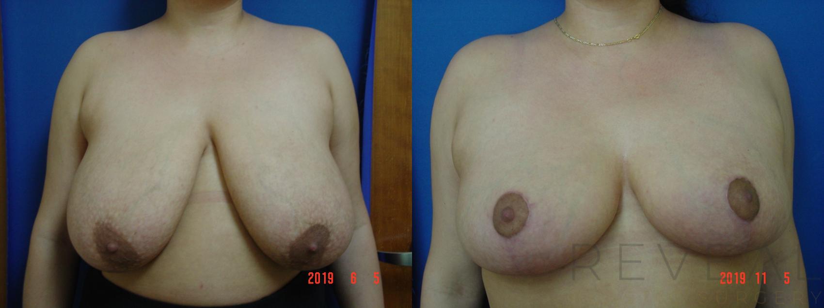 Before & After Breast Reduction Case 373 View #1 View in San Jose, CA