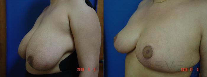 Before & After Breast Reduction Case 373 View #2 View in San Jose, CA