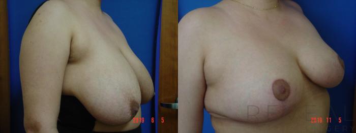 Before & After Breast Reduction Case 373 View #3 View in San Jose, CA