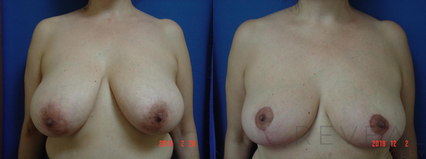 Before & After Breast Reduction Case 377 View #1 View in San Jose, CA