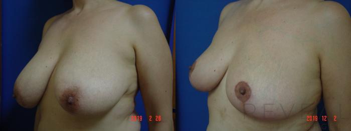 Before & After Breast Reduction Case 377 View #2 View in San Jose, CA