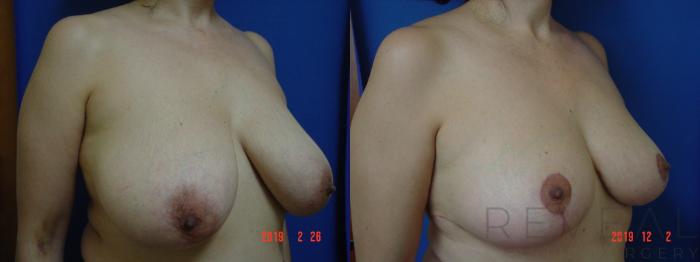 Before & After Breast Reduction Case 377 View #3 View in San Jose, CA