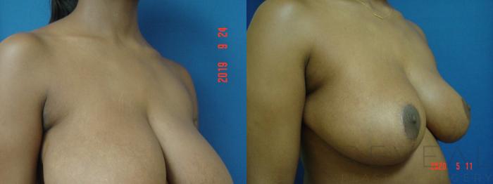 Before & After Breast Reduction Case 399 View #2 View in San Jose, CA