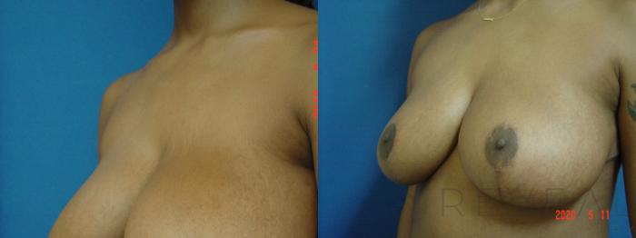 Before & After Breast Reduction Case 399 View #3 View in San Jose, CA