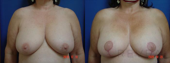 Before & After Breast Reduction Case 441 View #1 View in San Jose, CA