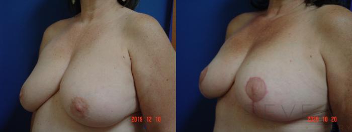 Before & After Breast Reduction Case 441 View #2 View in San Jose, CA