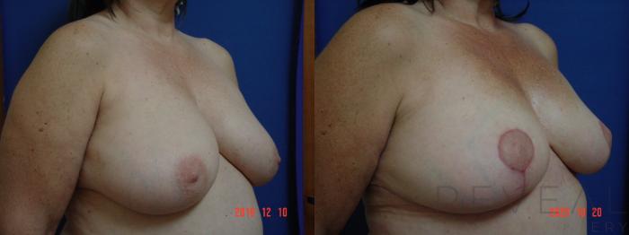 Before & After Breast Reduction Case 441 View #3 View in San Jose, CA