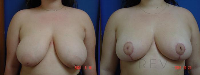 Before & After Breast Reduction Case 442 View #1 View in San Jose, CA