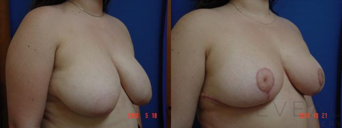 Before & After Breast Reduction Case 442 View #3 View in San Jose, CA