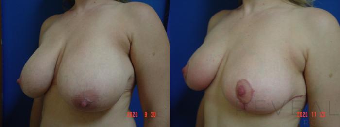 Before & After Breast Lift Case 457 View #2 View in San Jose, CA