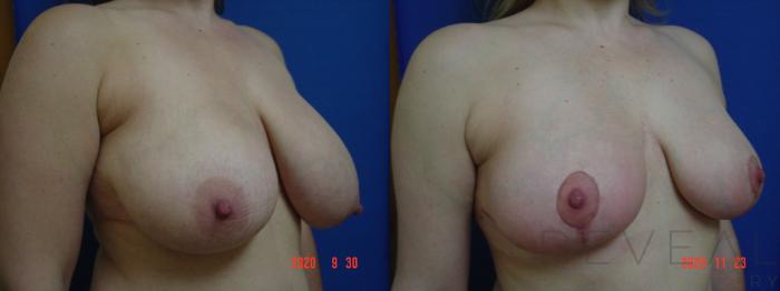 Before & After Breast Reduction Case 457 View #3 View in San Jose, CA