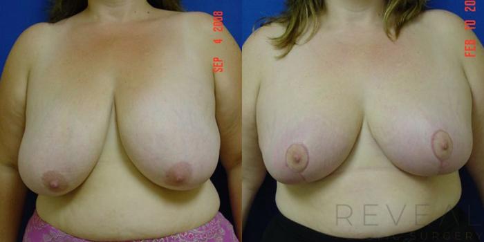 Before & After Breast Reduction Case 5 View #1 View in San Jose, CA