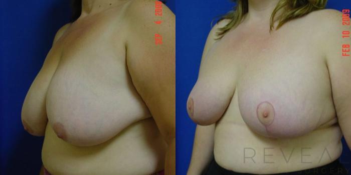 Before & After Breast Reduction Case 5 View #2 View in San Jose, CA