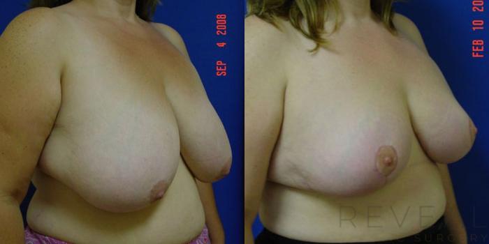 Before & After Breast Reduction Case 5 View #3 View in San Jose, CA