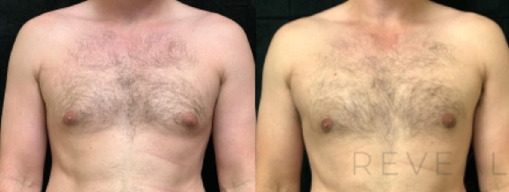 Before & After Male Breast Reduction  Gynecomastia  Case 561 View #1 View in San Jose, CA