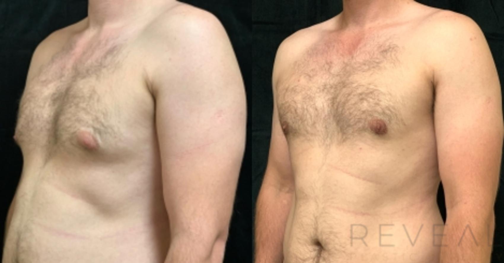 Before & After Male Breast Reduction Case 561 View #2 View in San Jose, CA
