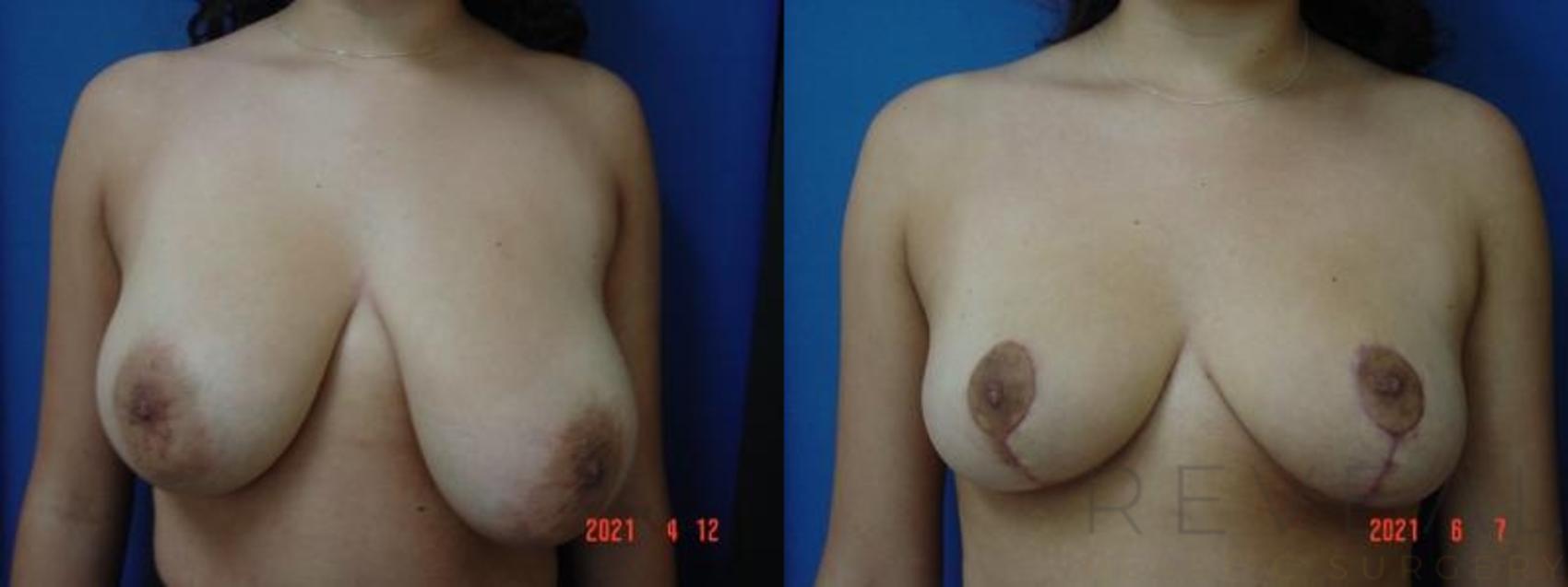 Before & After Breast Reduction Case 564 View #1 View in San Jose, CA