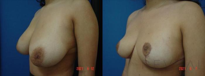 Before & After Breast Reduction Case 564 View #2 View in San Jose, CA