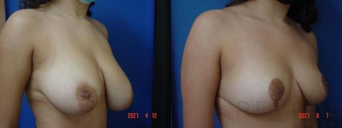 Before & After Breast Reduction Case 564 View #3 View in San Jose, CA