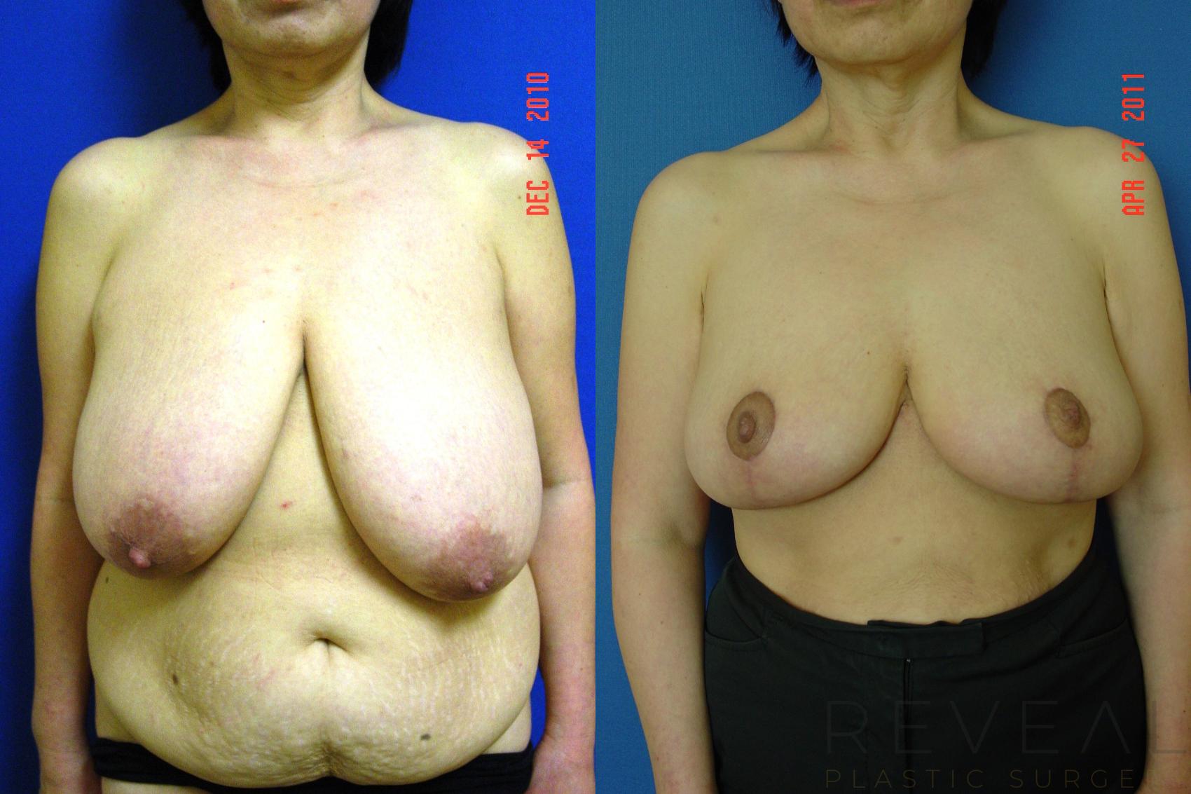Before & After Breast Reduction Case 66 View #1 View in San Jose, CA
