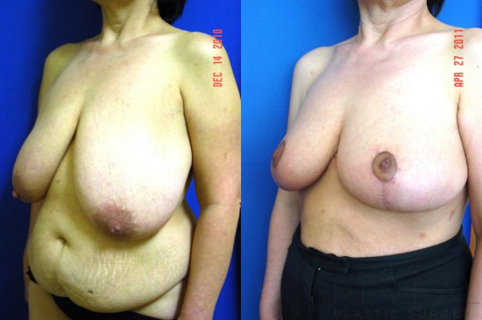 Before & After Breast Reduction Case 66 View #2 View in San Jose, CA