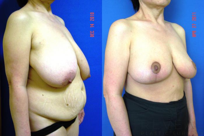 Before & After Breast Reduction Case 66 View #3 View in San Jose, CA