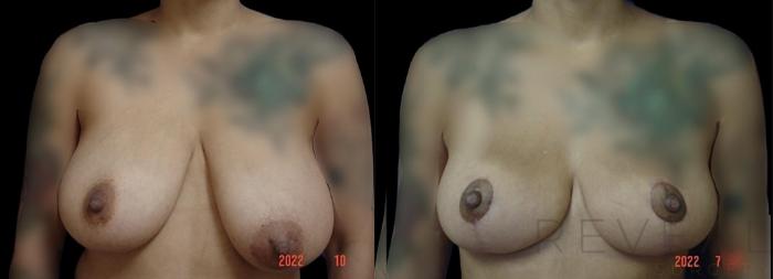 Before & After Breast Reduction Case 681 Front View in San Jose, CA