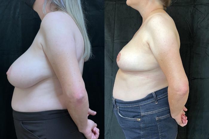 Before & After Breast Reduction Case 699 Right Oblique View in San Jose, CA