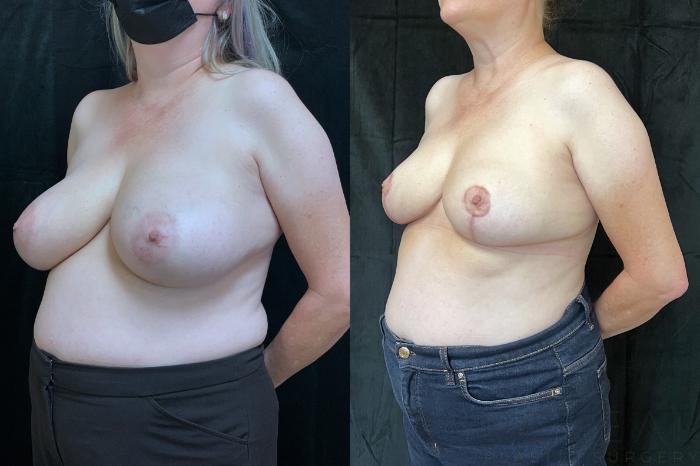 Before & After Breast Reduction Case 699 Right Side View in San Jose, CA